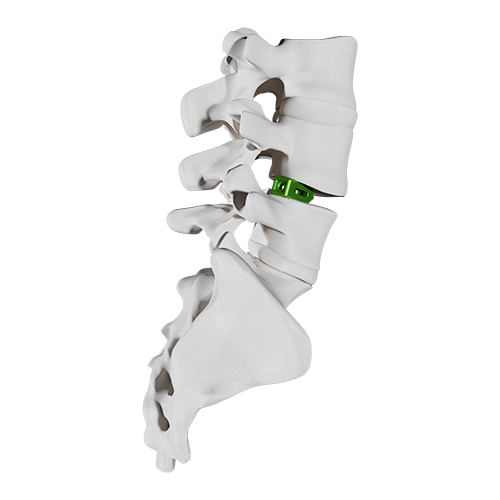 MICURA Bone Assembly